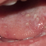 Герпес на язике: симптоми, причини, лечение