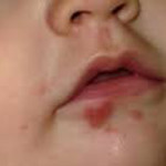 Герпес на губах у ребенка: причини, симптоми, лечение