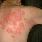 Герпес на спине: фото, симптоми, причини, лечение