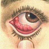 Герпес на глазах: фото, причини, симптоми, лечение