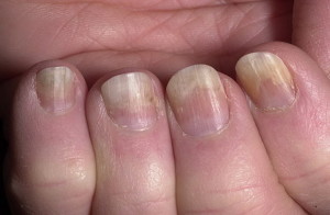 Псориаз ногтей: причини, симптоми, лечение, народние средства