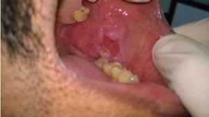 Пузырчатка слизистой оболочки полости рта