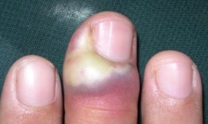 Панариций пальца - види, причини, симптоми, лечение
