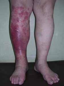 Рожистое воспаление ноги - что делать при возникновении симптомов?
