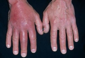 Рожистое воспаление руки - причини, симптоми, лечение, народние средства