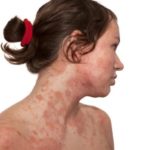 аллергический дерматит у взрослых