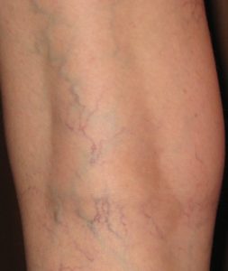 Варикозная экзема на ногах - лечение и профилактика венозной экземы. Экзема варикозы нижних конечностей