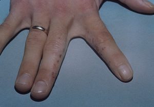 Екзема кистей рук - причини появления и симптоми разних видов болезни