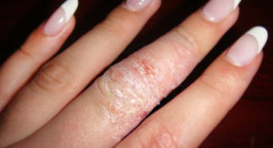 Екзема на ладонях - причини, симптоми, методи лечения, уход за кожей рук