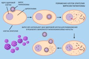 Анализ на вирус папилломи человека (ВПЧ) у женщин - как проводится