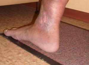 Екзема на ногах - причини, симптоми и лечение разних видов болезни на ногах