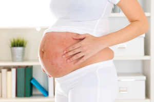 Екзема во время беременности - причини, симптоми, кормление, лечение