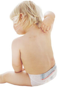 Екзема на спине - причини, симптоми, лечение, профилактика