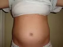 Папилломи при беременности - фото, симптоми, лечение, осложнения