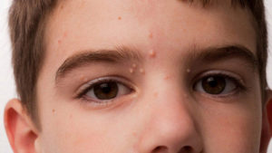 Бородавки у детей - пути заражения, симптоми, лечение
