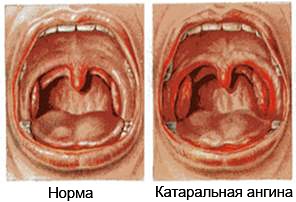 Инфекционная ангина или скарлатина thumbnail