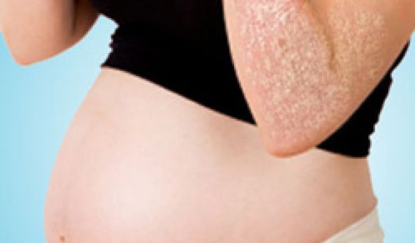 Псориаз у женщин: при беременности, симптомы, лечение