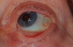 Пузырчатка глаз или рубцующий пемфигоид