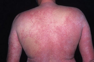 Атопический дерматит у взрослых на спине