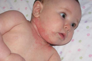 Атопический дерматит у детей - как выглядит