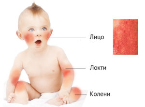 Атопический дерматит у детей - расположение