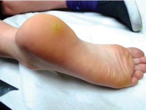 Папилломы на ногах фото и лечение thumbnail