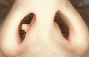 Как выглядят папилломы в носу