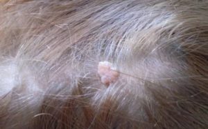 Папилломы на голове в волосах
