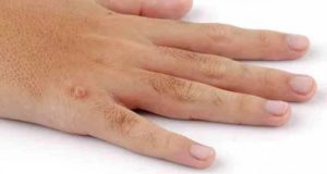 Эндодермальная папиллома на пальце руки thumbnail