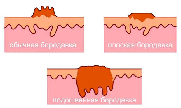 Все виды бородавок фото