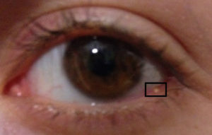 Жировик на роговице глаза человека thumbnail