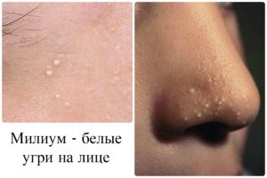 Внутренний жировик на носу