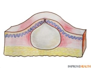 Жировик на лобковой части у женщин