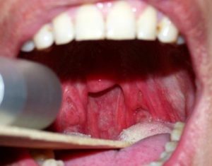 Кондиломы во рту, на языке и губах: лечение и удаление