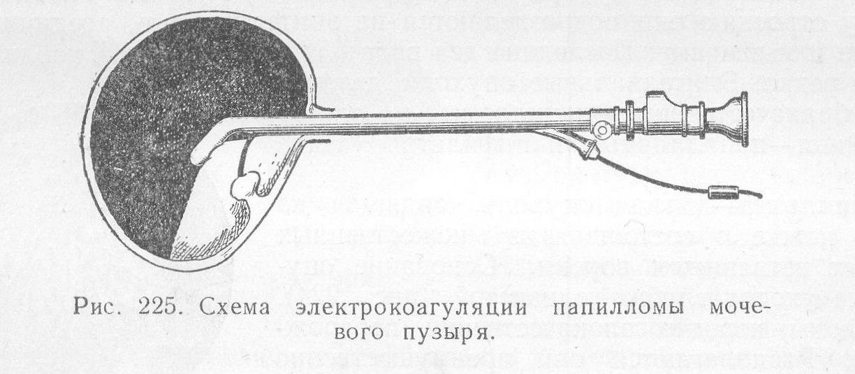 Папилломы мочевого пузыря - фото, причины, симптомы, лечение