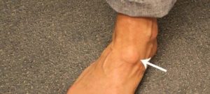 Жировик на косточке большого пальца ноги