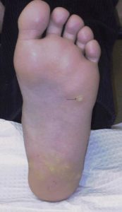 Жировик на косточке большого пальца ноги thumbnail