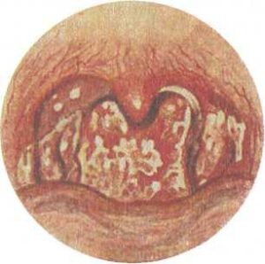 Фото грибковой ангины у взрослых thumbnail