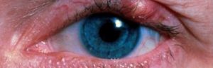 Грибковые поражения глаз фото на лице у женщин лечение thumbnail
